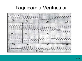 Taquicardia Ventricular