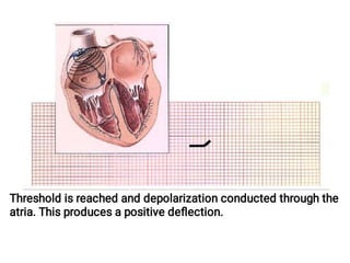 Threshold is reached and depolarization conducted through the
atria. This produces a positive deﬂection.
 