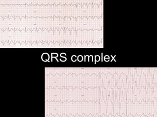 QRS complex
 