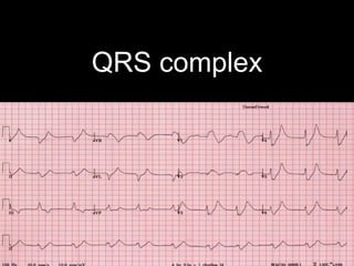QRS complex
 