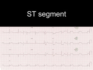 ST segment
 