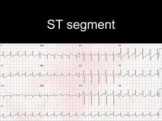 ST segment
 