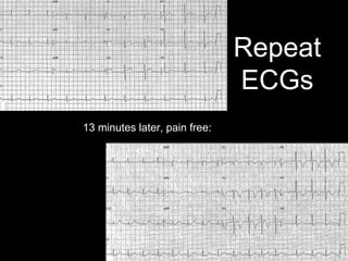 Repeat
ECGs
13 minutes later, pain free:
 
