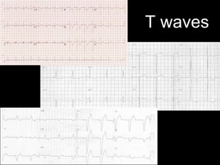 T waves
 
