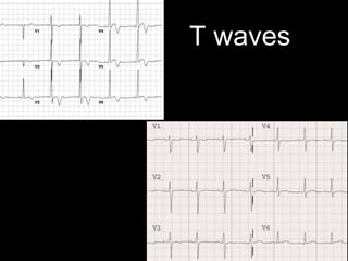 T waves
 
