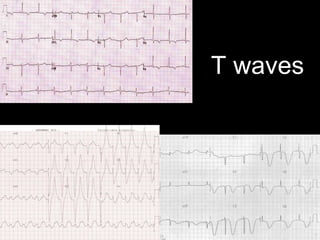 T waves
 