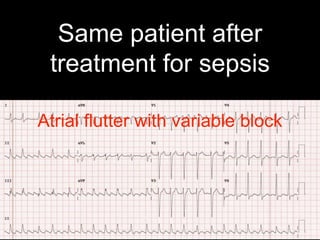 Same patient after
treatment for sepsis
A
Atrial flutter with variable block
 
