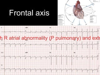 Frontal axis
h R atrial abnormality (P pulmonary) and extr
 