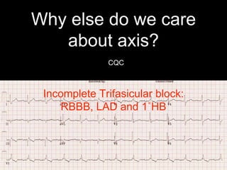 Why else do we care
about axis?
CQC
Incomplete Trifasicular block:
RBBB, LAD and 1˚HB
 