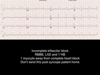 Incomplete trifascilar block
RBBB, LAD and 1˚HB
1 myocyte away from complete heart block
Don’t send this post syncope patient home
 