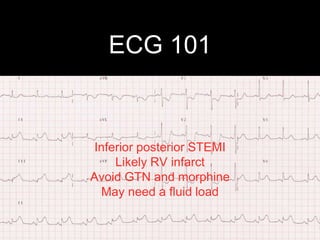 ECG 101
Inferior posterior STEMI
Likely RV infarct
Avoid GTN and morphine
May need a fluid load
 