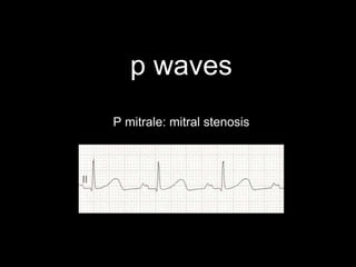p waves
P mitrale: mitral stenosis
 