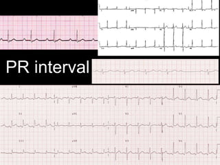 PR interval
 