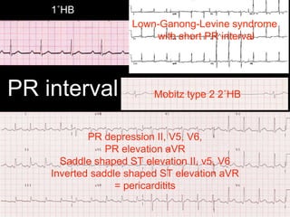 PR interval
1˚HB
Lown-Ganong-Levine syndrome
with short PR interval
Mobitz type 2 2˚HB
PR depression II, V5, V6,
PR elevation aVR
Saddle shaped ST elevation II, v5, V6
Inverted saddle shaped ST elevation aVR
= pericarditits
 