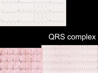 QRS complex
 
