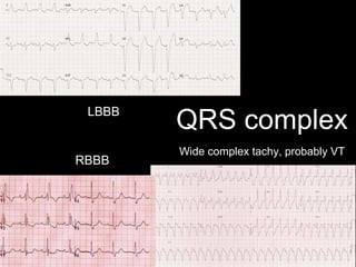 QRS complex
Wide complex tachy, probably VT
LBBB
RBBB
 