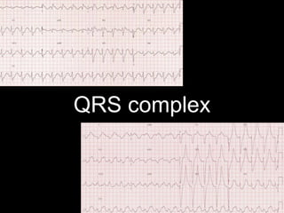 QRS complex
 