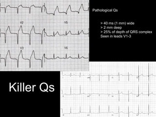 Killer Qs
Pathological Qs
> 40 ms (1 mm) wide
> 2 mm deep
> 25% of depth of QRS complex
Seen in leads V1-3
 