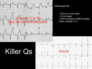 Killer Qs
Pathological Qs
> 40 ms (1 mm) wide
> 2 mm deep
> 25% of depth of QRS complex
Seen in leads V1-3
Q waves 2˚ to MI
May still be thrombolysable
HOCM
 