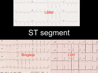 ST segment
LBBB
LVHBrugada
 