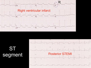 ST
segment
R
Right ventricular infarct
Posterior STEMI
 