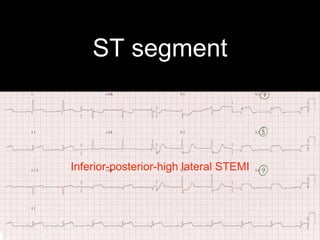 ST segment
Inferior-posterior-high lateral STEMI
 