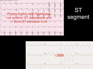 ST
segment
Paced rhythm with Sgarbossa
+ve anterior ST depression and
> 5mm ST elevation in III
LBBB
 