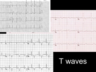 T waves
 