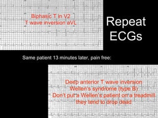 Repeat
ECGs
Same patient 13 minutes later, pain free:
Biphasic T in V2
T wave inversion aVL
Deep anterior T wave inversion
Wellen’s syndrome (type B)
Don’t put a Wellen’s patient on a treadmill
they tend to drop dead
 