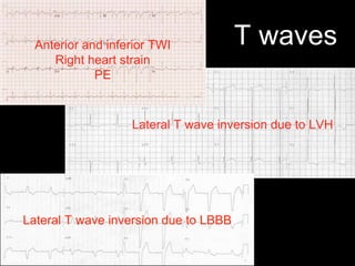 T wavesAnterior and inferior TWI
Right heart strain
PE
Lateral T wave inversion due to LVH
Lateral T wave inversion due to LBBB
 
