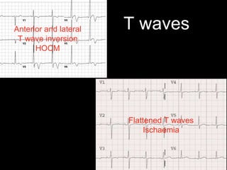 T wavesAnterior and lateral
T wave inversion
HOCM
Flattened T waves
Ischaemia
 