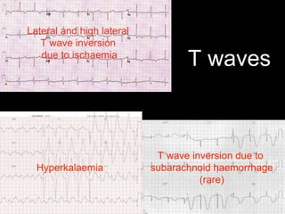 T waves
Lateral and high lateral
T wave inversion
due to ischaemia
T wave inversion due to
subarachnoid haemorrhage
(rare)
Hyperkalaemia
 
