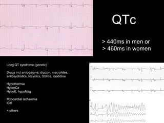 QTc
Long QT syndrome (genetic)
Drugs incl amiodarone, digoxin, macrolides,
antipsychotics, tricyclics, SSRIs, loratidine
Hypothermia
HyperCa
HypoK, hypoMag
Myocardial ischaemia
ICH
+ others
> 440ms in men or
> 460ms in women
 