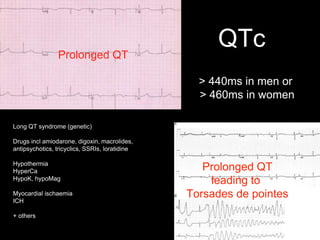 QTc
Long QT syndrome (genetic)
Drugs incl amiodarone, digoxin, macrolides,
antipsychotics, tricyclics, SSRIs, loratidine
Hypothermia
HyperCa
HypoK, hypoMag
Myocardial ischaemia
ICH
+ others
> 440ms in men or
> 460ms in women
Prolonged QT
Prolonged QT
leading to
Torsades de pointes
 