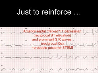 Just to reinforce …
Anterior-septal marked ST depression
(reciprocal ST elevation)
and prominent S R waves
(reciprocal Qs)
=probable posterior STEMI
 