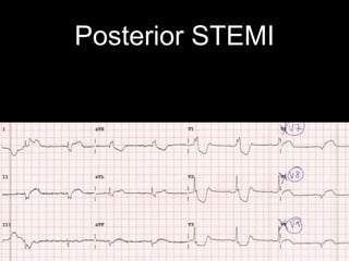 Posterior STEMI
 