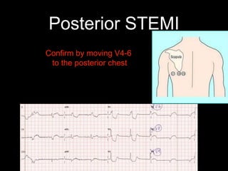 Posterior STEMI
Confirm by moving V4-6
to the posterior chest
 