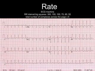 ECG machine
RR interval big squares: 300, 150, 100, 75, 60, 50
total number of complexes across the page x 6
Rate
 