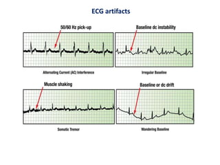 ECG artifacts
 
