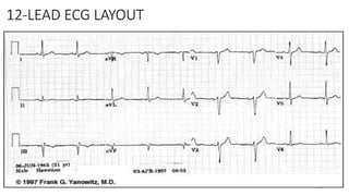 28
12-LEAD ECG LAYOUT
 