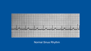 Normal Sinus Rhythm
 