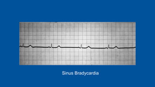 Sinus Bradycardia
 