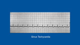 Sinus Tachycardia
 