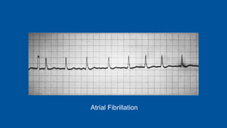 Atrial Fibrillation
 