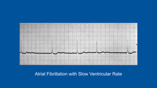 Atrial Fibrillation with Slow Ventricular Rate
 