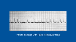 Atrial Fibrillation with Rapid Ventricular Rate
 