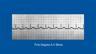First Degree A-V Block
 