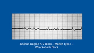 Second Degree A-V Block – Mobitz Type I –
Wenckebach Block
 