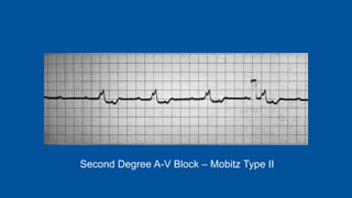 Second Degree A-V Block – Mobitz Type II
 