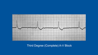 Third Degree (Complete) A-V Block
 